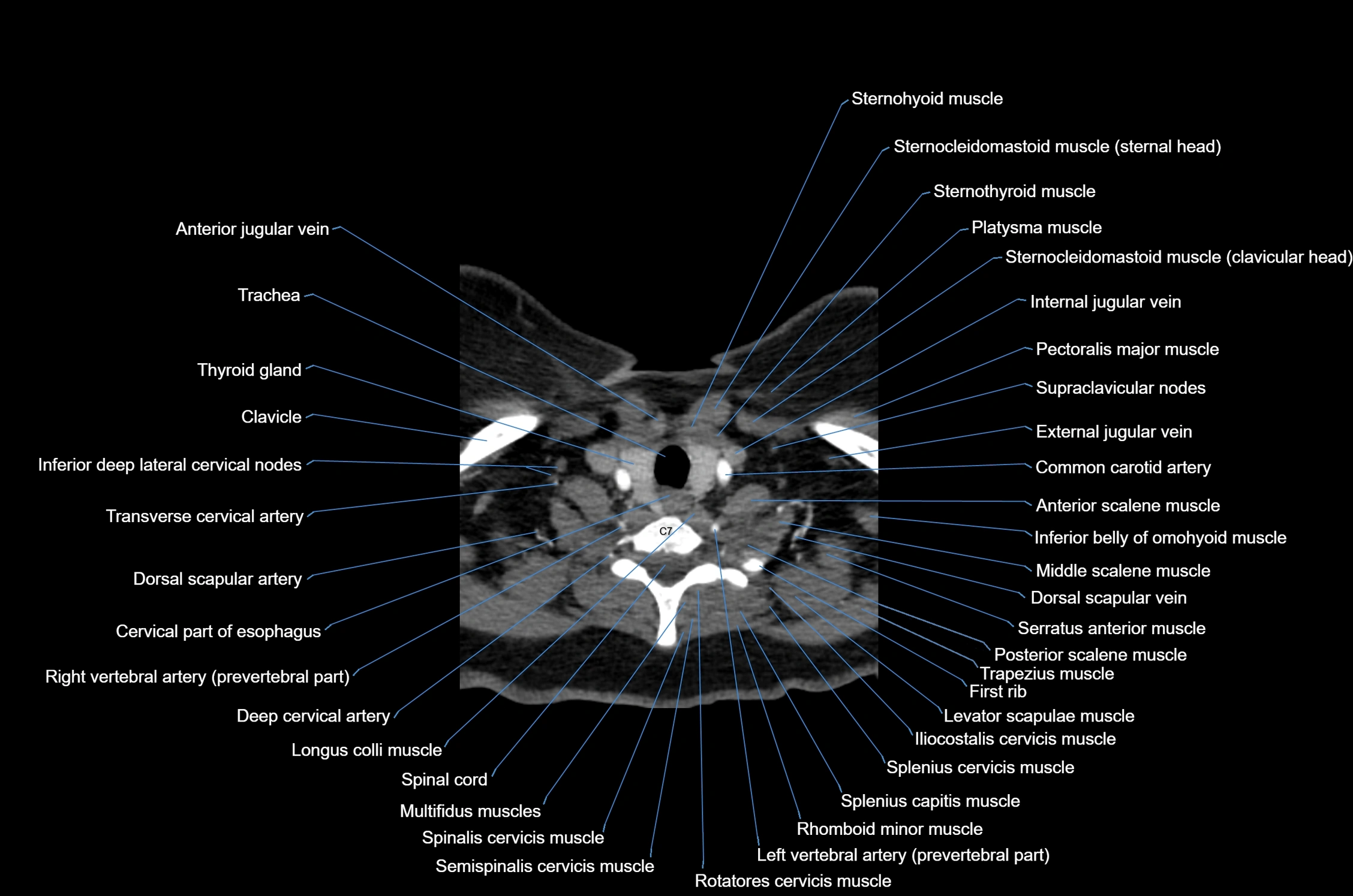 CT Neck axial cross sectional anatomy radiology image-img-00001-00050.webp